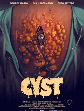 Cyst